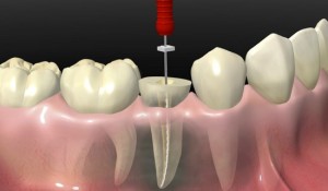 endodonzia